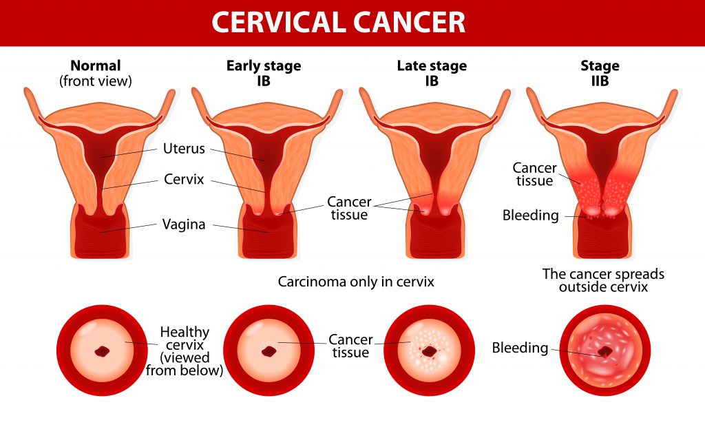 10-warning-signs-of-cervical-cancer-you-shouldn-t-ignore-easy-recipes