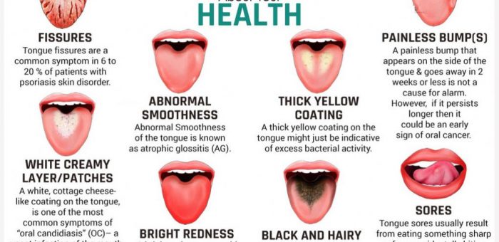 Bumps On Back Of Tongue - Symptoms Bumps On Back Of Tongue - Symptoms