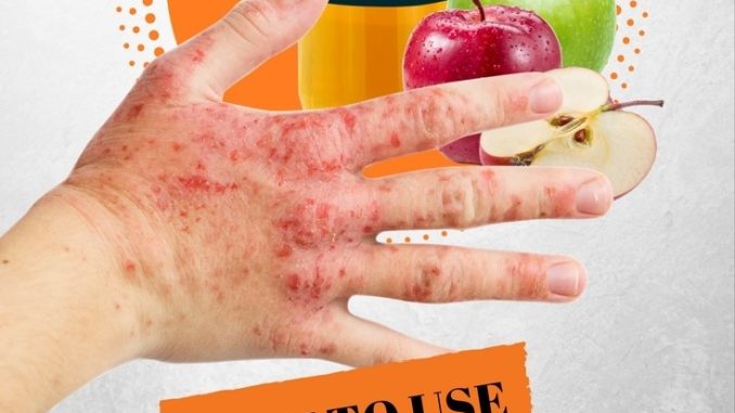 appelciderazijn acne