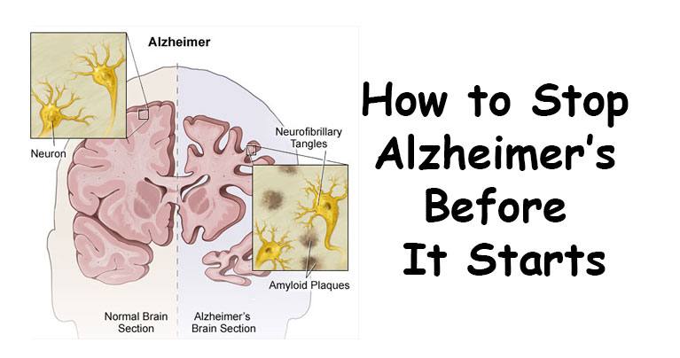 running head alzheimer’s disease Detection of alzheimer’s disease 4 “measureable changes in biomarkers (such as brain imaging and spinal fluid chemistry) that indicate the very earliest signs of disease, before outward symptoms are visible” (pies, 2012, p. running head alzheimer’s disease Detection of alzheimer’s disease 4 “measureable changes in biomarkers (such as brain imaging and spinal fluid chemistry) that indicate the very earliest signs of disease, before outward symptoms are visible” (pies, 2012, p.