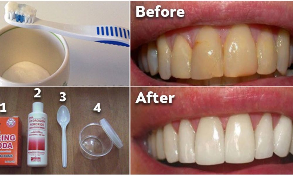How To Get Rid Of Plaque and Whiten Your Teeth Without 