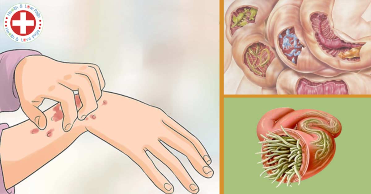 Natural Ways To Rid Your Body Of Parasites Natural Ways To Rid Your Body Of Parasites