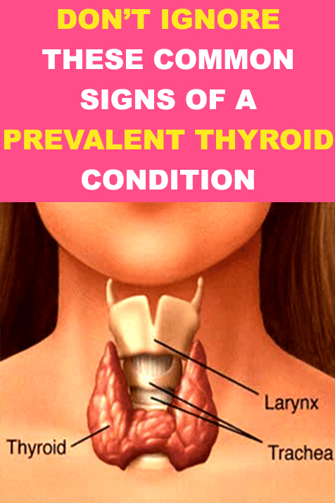 Don’t ignore these common signs of a prevalent thyroid condition